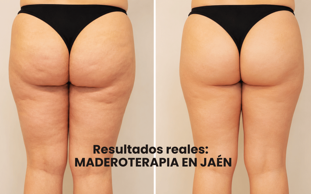 maderoterapia Jaén